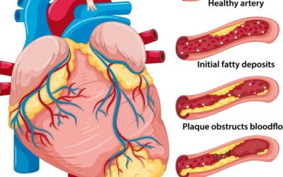 Aterosclerosis: tres puntos claves que debes conocer sobre la enfermedad