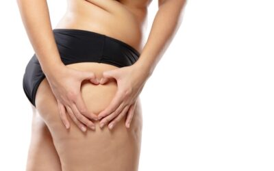 Celulitis y flaciedez, relacionadas a la retención de líquidos según expertos