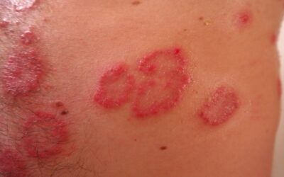 La psoriasis es más que una mancha en la piel