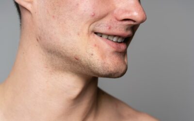 Acné, poros dilatados y manchas: Problemas comunes en el hombre