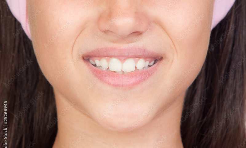 Bruxismo y desgaste dental
