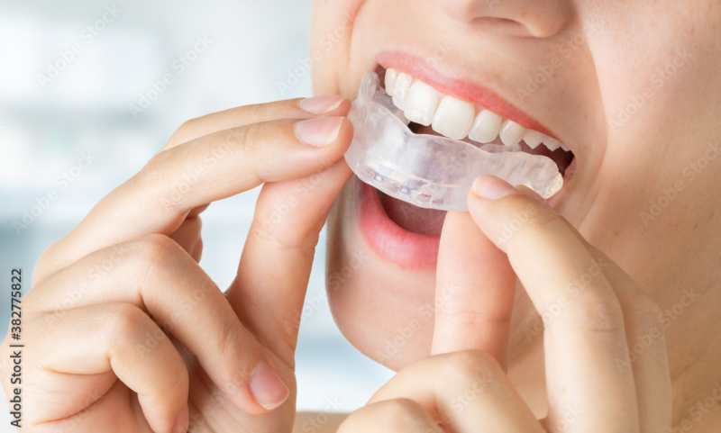 Bruxismo y desgaste dental