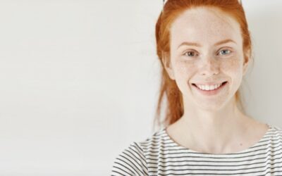 El melasma y su tratamiento
