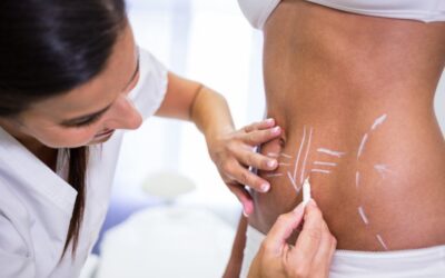 Lipo HD ¿En qué consiste?