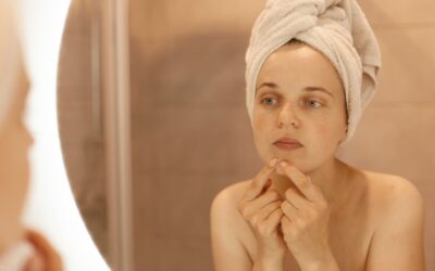 Melasma, afección que ataca nuestra piel