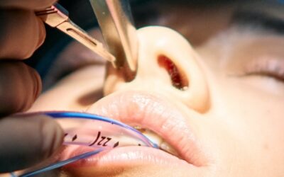 La rinoplastia moderna es más armónica