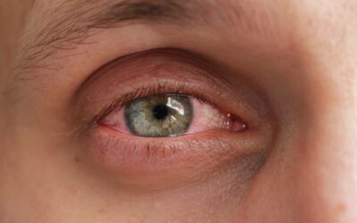 Conjuntivitis alérgica: cuáles son sus síntomas y cómo aliviarlos