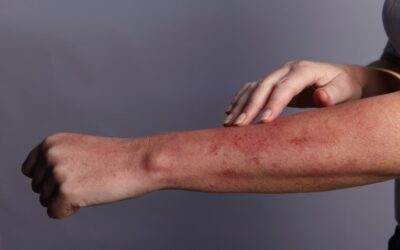 Toxicodermia: Qué es y sus principales reacciones