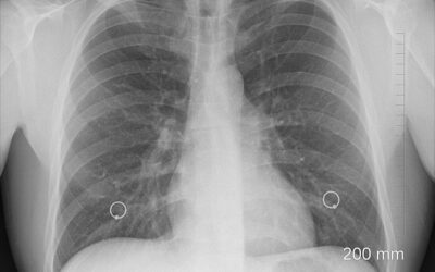 Alertan de repuntes de casos de tuberculosis en Venezuela