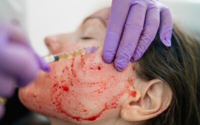 Estiramiento facial de vampiro: Qué es y en qué consiste