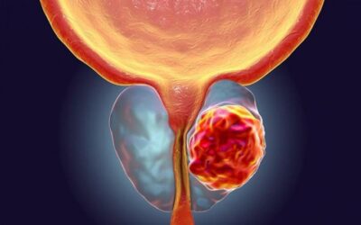 Cáncer de próstata: tipos, síntomas y quiénes están en riesgo