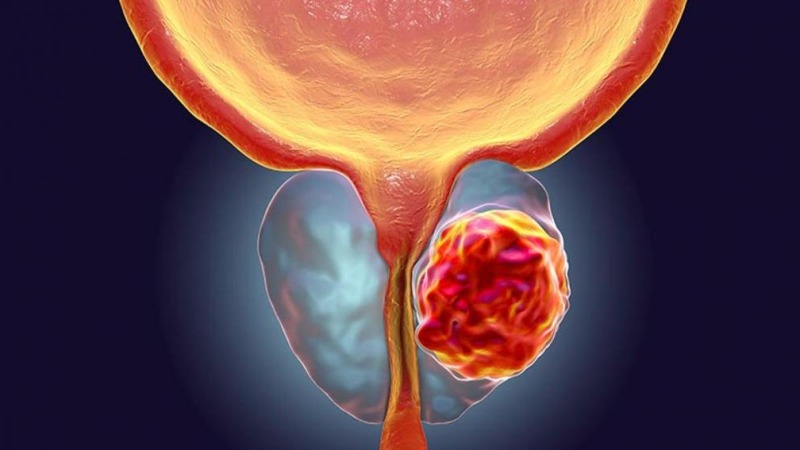 Cáncer de próstata: tipos, síntomas y quiénes están en riesgo