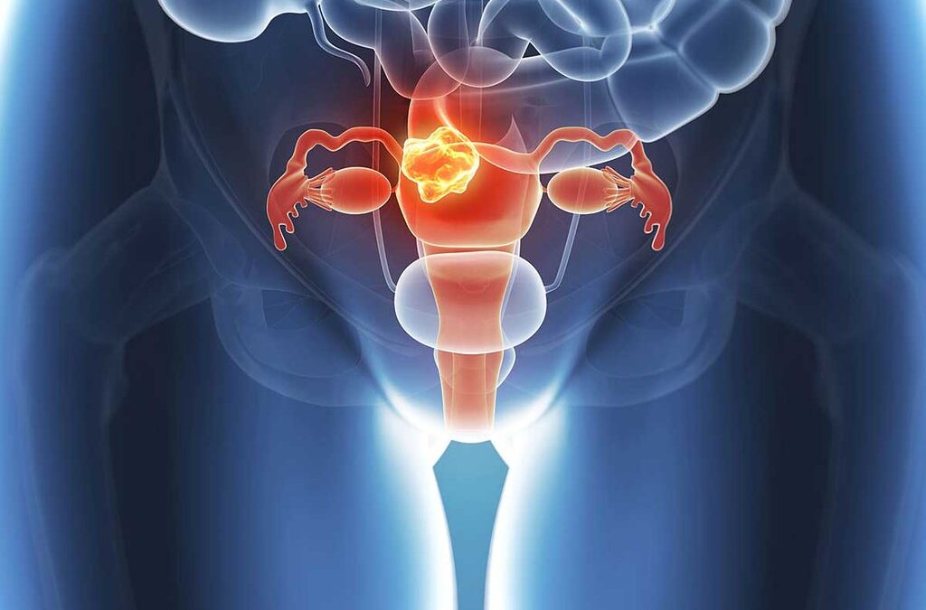 Ovarios Poliquísticos: cambios en el estilo de vida que lo mejoran