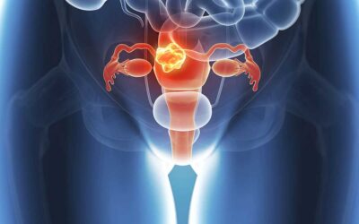 Ovarios Poliquísticos: cambios en el estilo de vida que lo mejoran