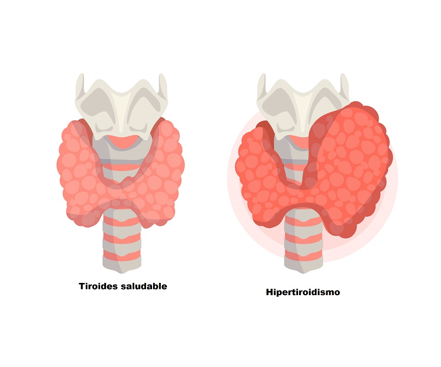 Tiroides