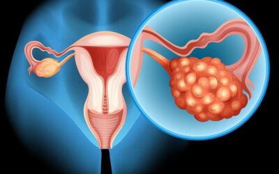 Miomas uterinos: ¿siempre se operan?