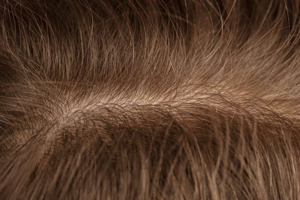 ¿Cuáles son las razones asociadas a las alergias en el cuero cabelludo?