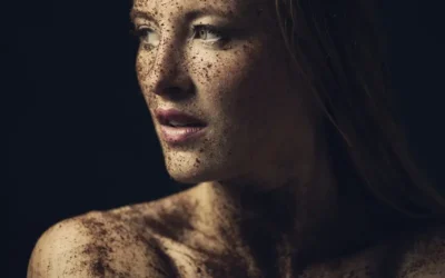 Melasma | El término correcto para las manchas en la cara