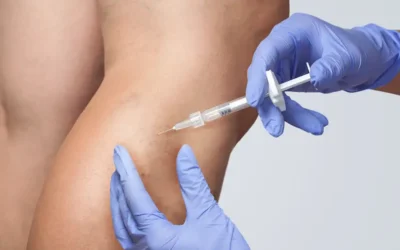 Método de escleroterapia para varices y arañas vasculares