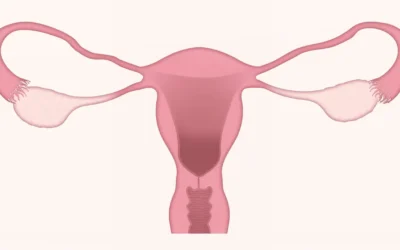 Pesario vaginal| Una solución para el prolapso