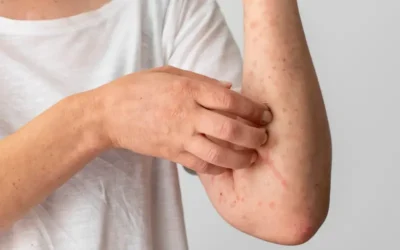 Aciclovir: qué es, cómo usarlo y sus efectos secundarios