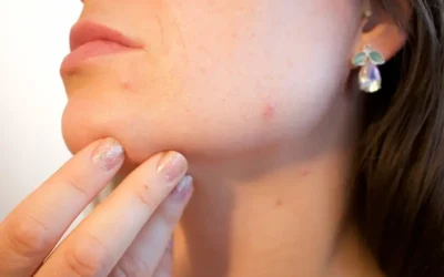 Tratamiento del lupus: la enfermedad que afecta a más mujeres que a hombres