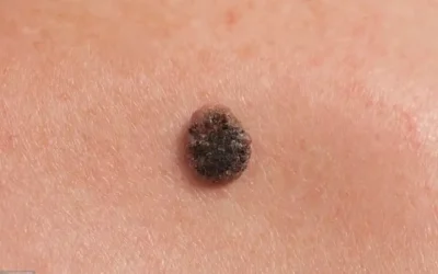 El melanoma ¿Qué es y cuáles son sus síntomas?