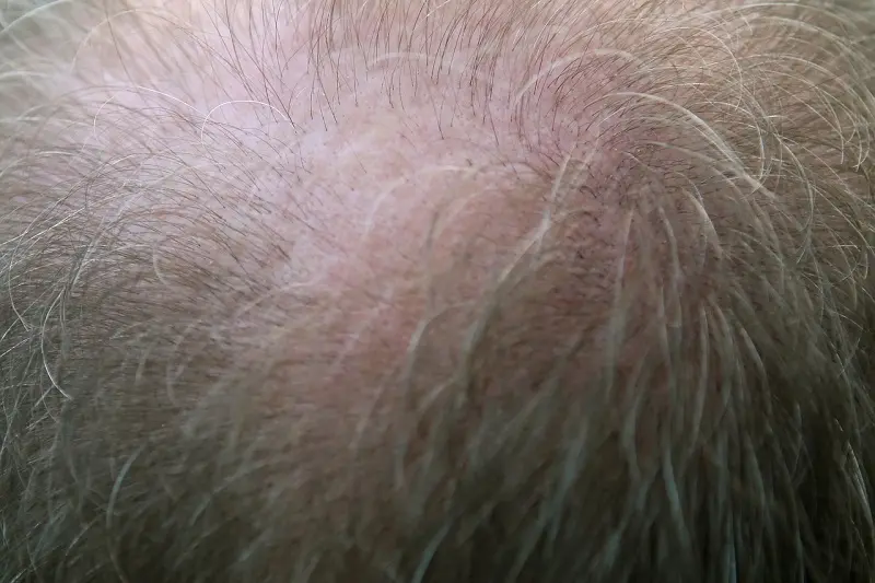 Dile adiós a la alopecia y no a tu cabello