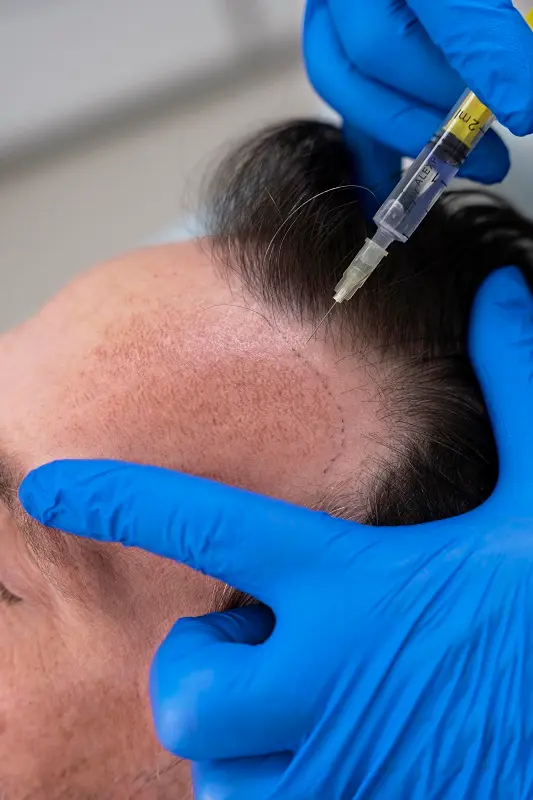 Dile adiós a la alopecia y no a tu cabello