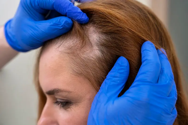 Dile adiós a la alopecia y no a tu cabello