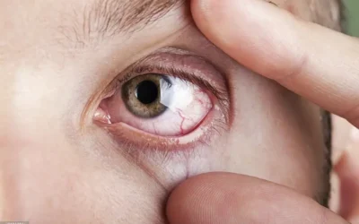Síndrome del ojo seco: causas y tratamiento