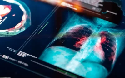 Nuevo tratamiento del cáncer del pulmón aumenta la esperanza de vida