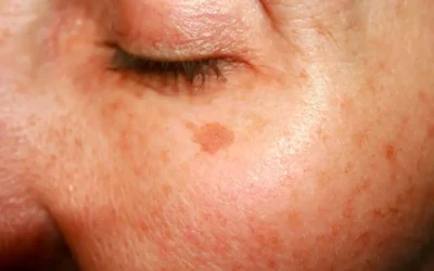 Productos y tratamientos que pueden ayudarte a eliminar o aclarar las manchas por el sol