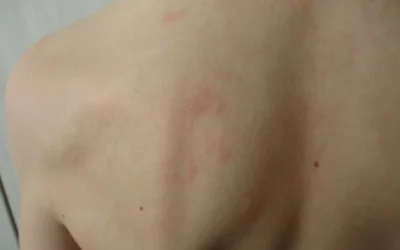 ¿Qué nos pasa si tenemos urticaria por frío? Síntomas y cómo tratarla