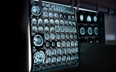 Un nuevo rayo de esperanza en la lucha contra el Alzheimer: la FDA aprueba donanemab