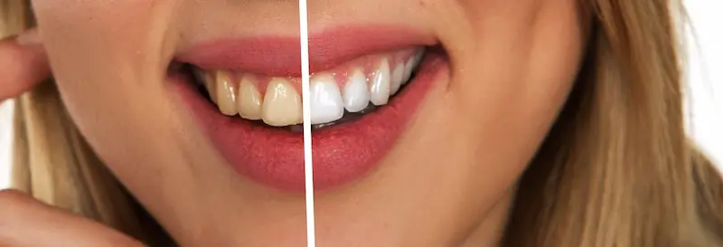 dientes amarillos