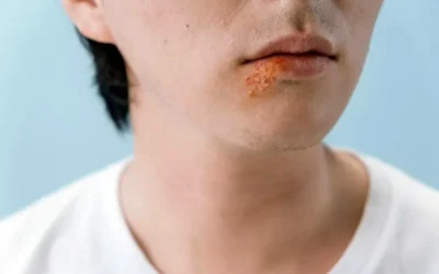 Herpes Labial: Un Virus que Remodela el Genoma Humano
