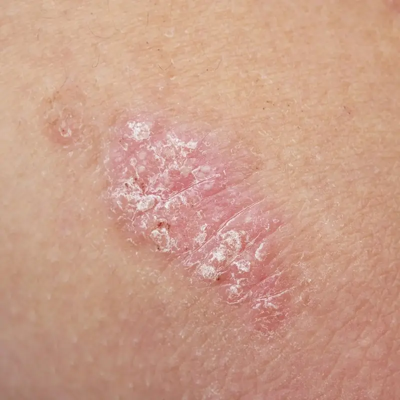 psoriasis nerviosa