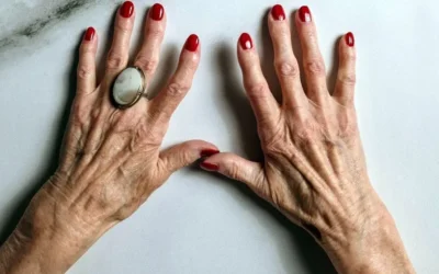 Nódulos de Bouchard: Qué Son y Por Qué Aparecen