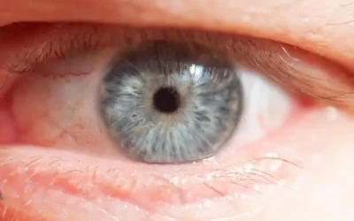 Conjuntivitis: ¿Cuándo Usar Antibióticos y Cuándo No?