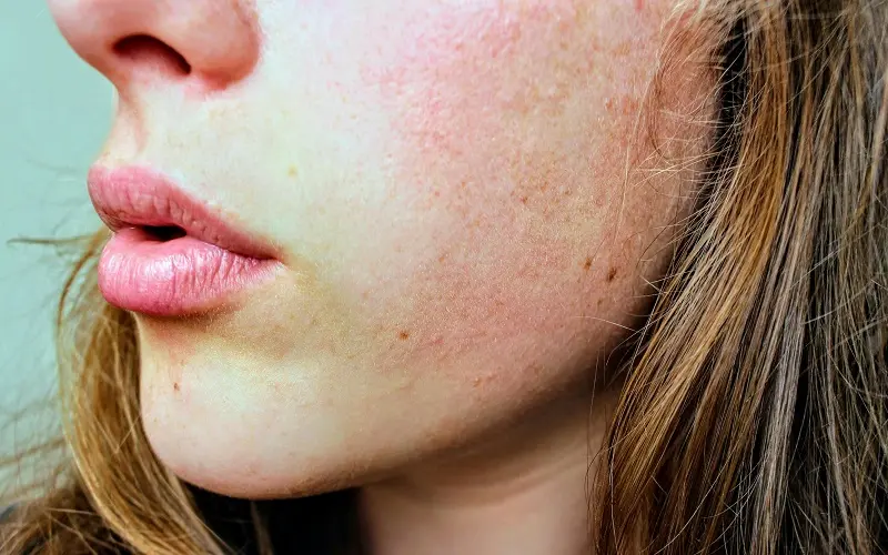 psoriasis nerviosa