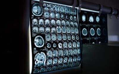 Epilepsia: Desmitificando el trastorno eléctrico cerebral común