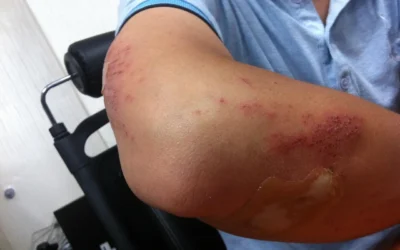 Moretones sin golpes: ¿Por qué aparecen y cuándo deberías preocuparte?