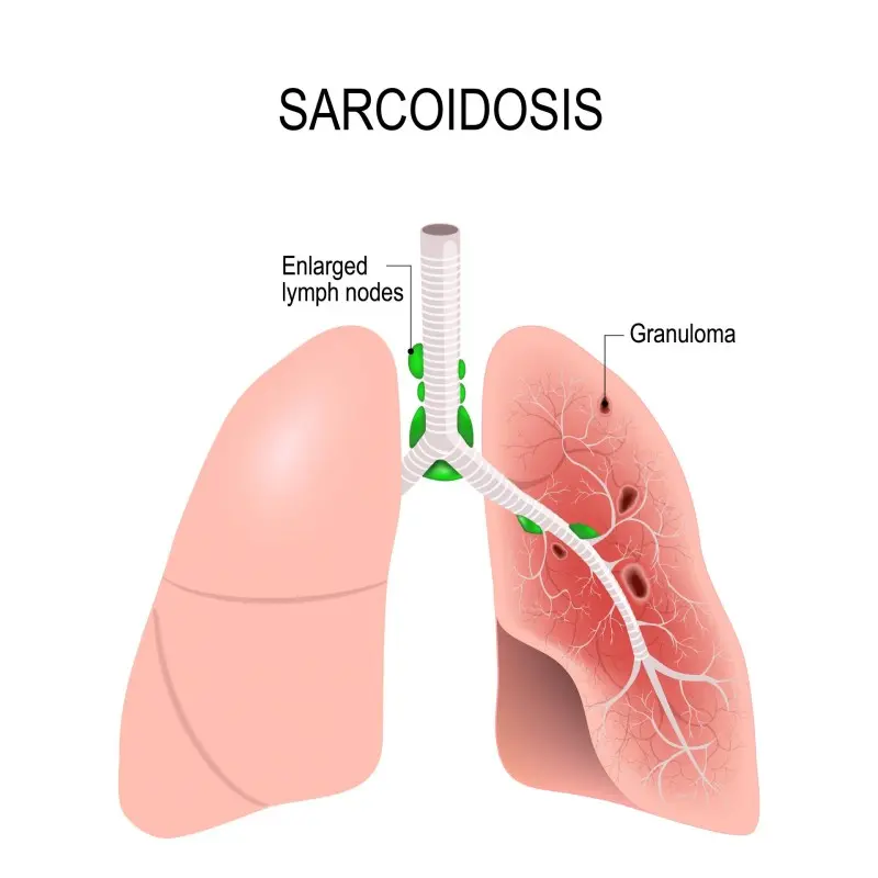 Sarcoidosis